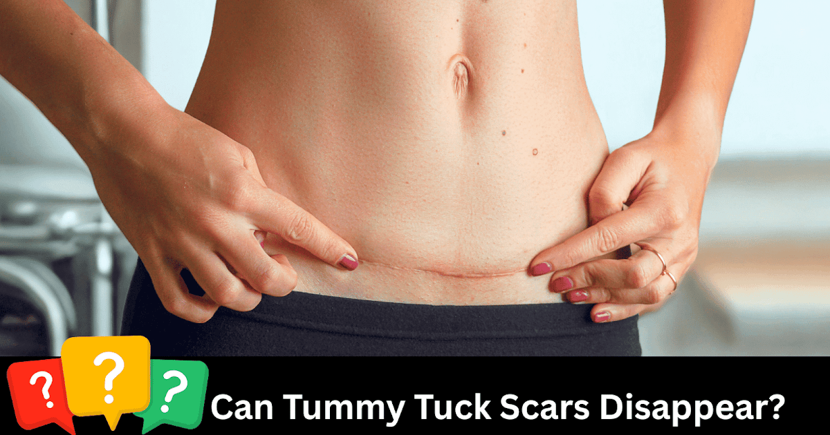 Do Tummy Tuck Scars Disappear—Or Can They Develop into a Masterpiece? Do Tummy Tuck Scars Disappear—Or Can They Develop into a Masterpiece?