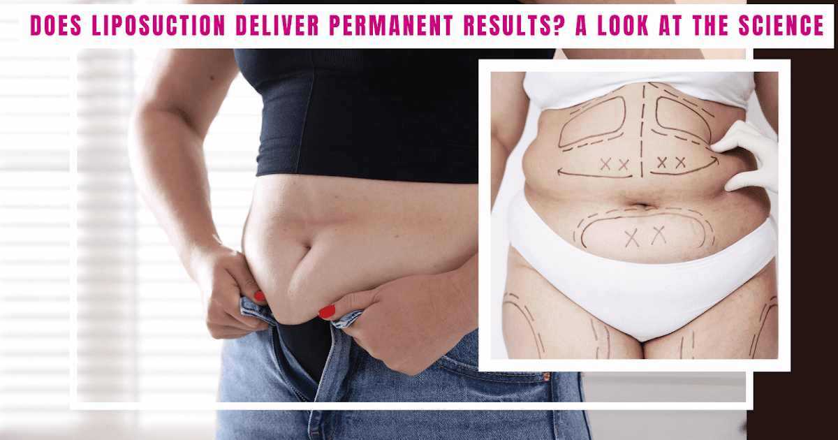 Does Liposuction Ship Everlasting Outcomes? A Have a look at the Science