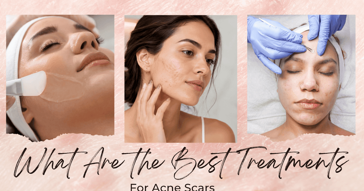 What Are the Finest Remedies for Pimples Scars?