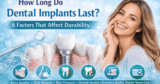 How Lengthy Do Dental Implants Final? 6 Components That Have an effect on Sturdiness